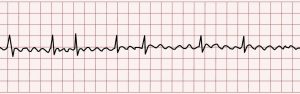 Atrial Fibrillation ECG