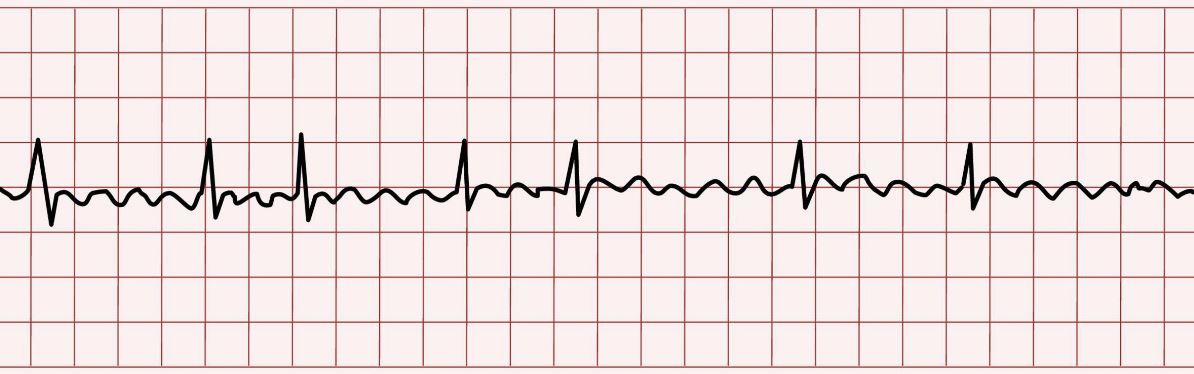 Atrial Fibrillation ECG