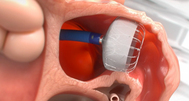 What is Left Atrial Appendage Closure with the Watchman Device?