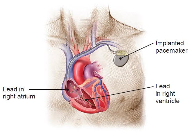 human heart with a dual chamber pacemaker